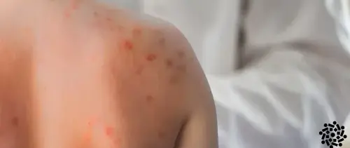Criança de costas apresenta manchas vermelhas na pele, que são características de sarampo